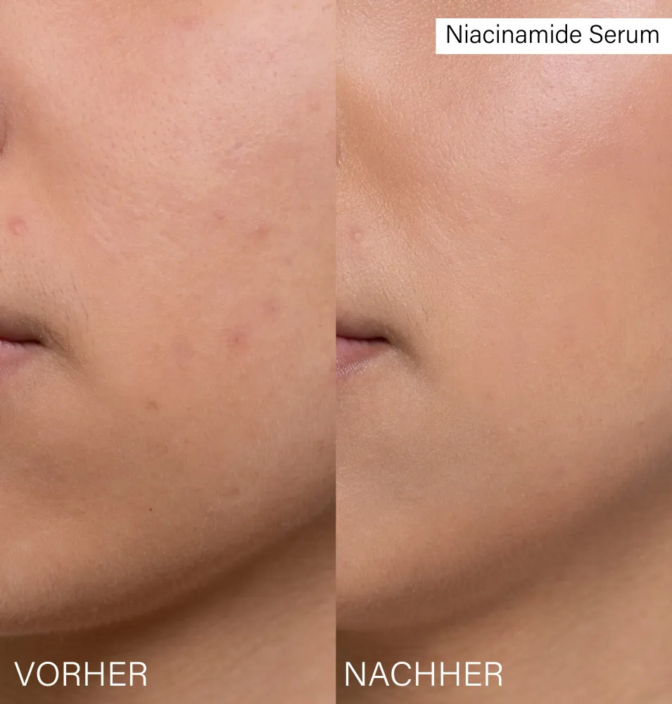 Niacinamide Serum